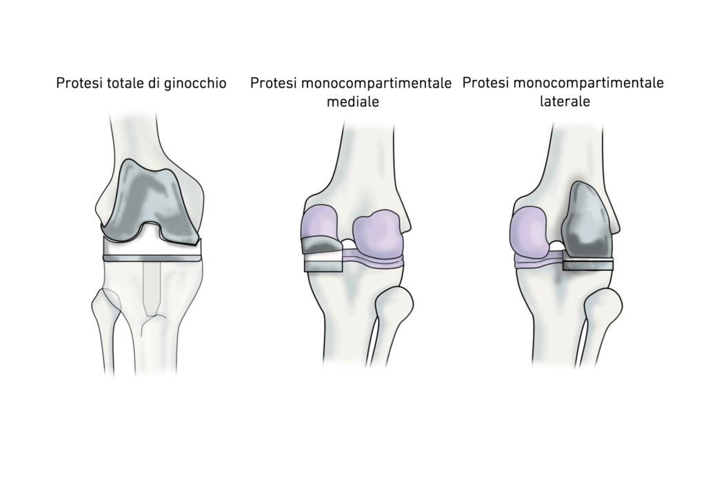 KOOS: protesi ginocchio