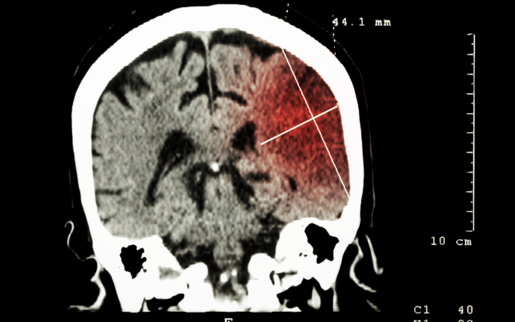 Motricity Index: ictus TAC