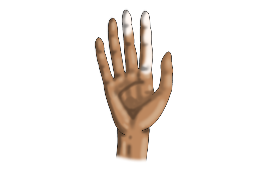 Manovra di Phalen: sintomi