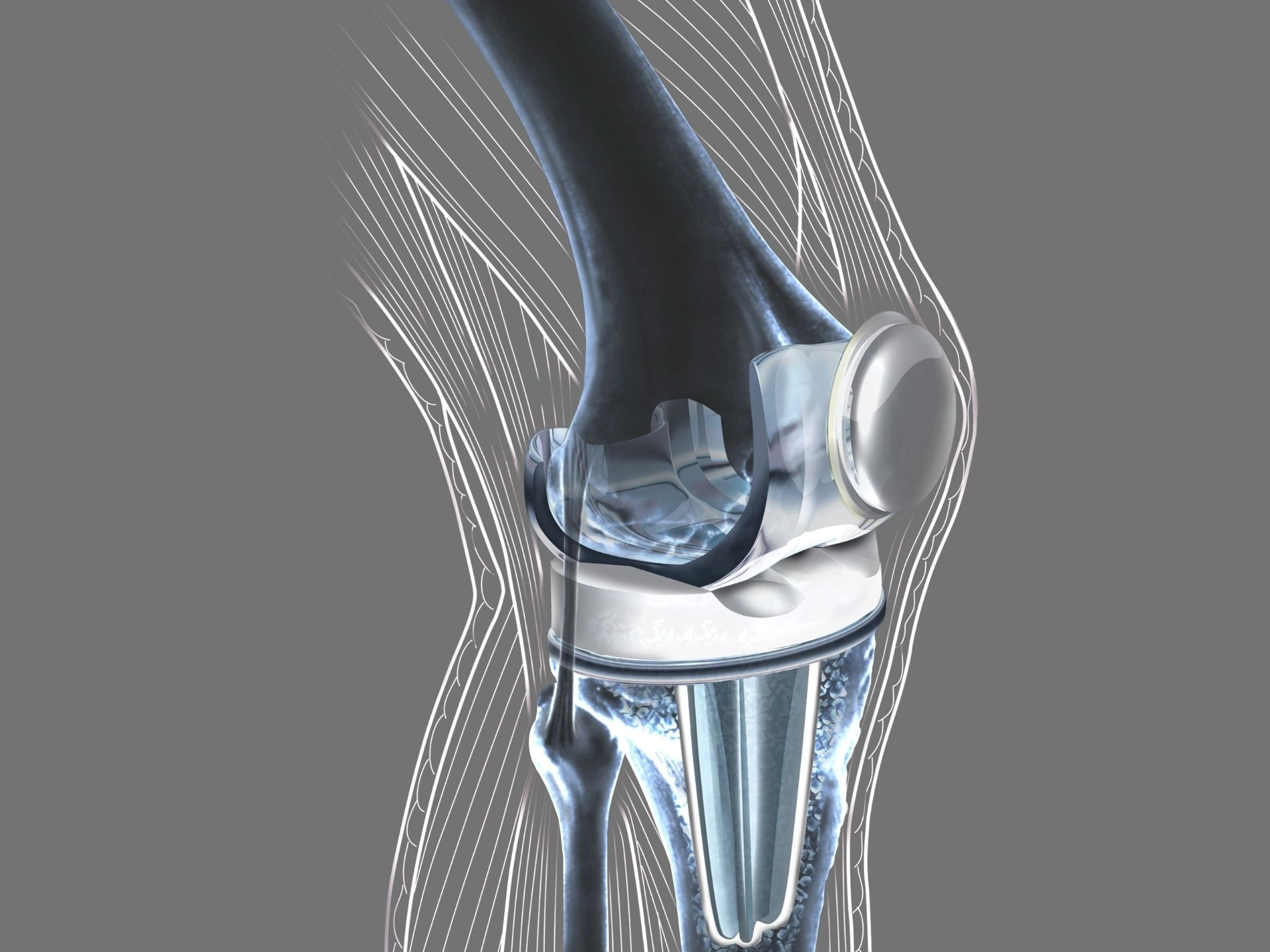 болит эндопротез