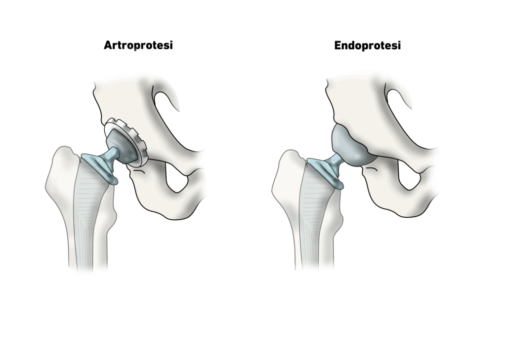 UCLA Activity Score: protesi anca
