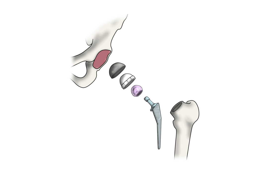 Oxford Hip Score: protesi