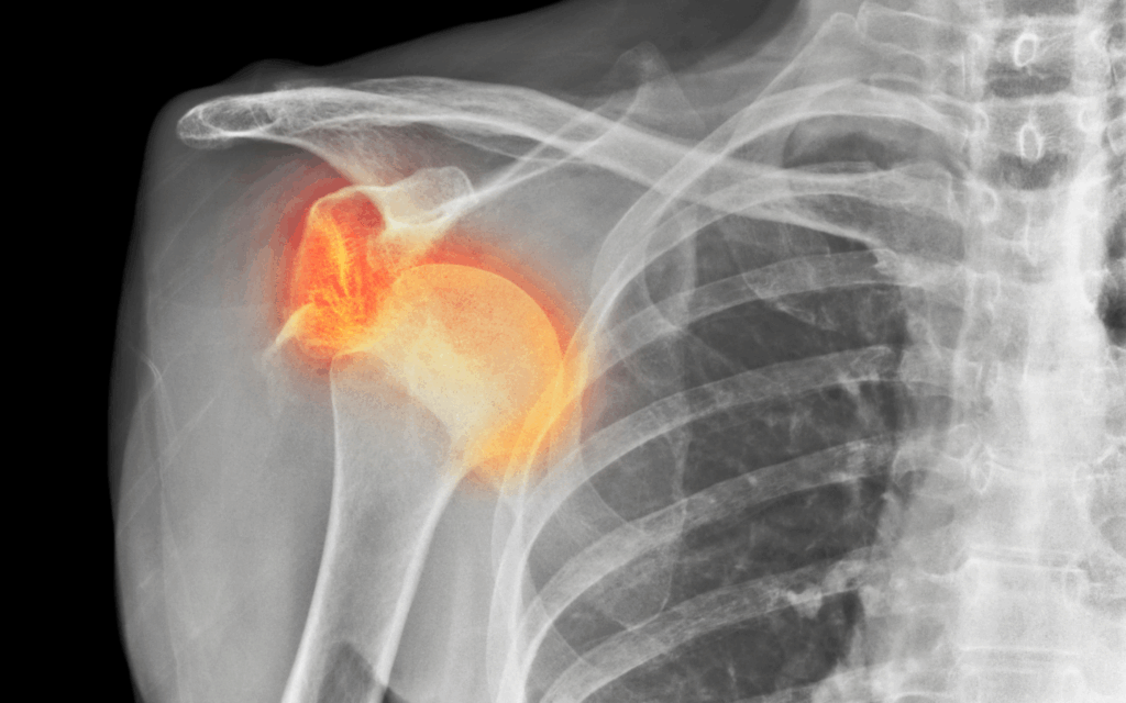Oxford Shoulder Instability Score
