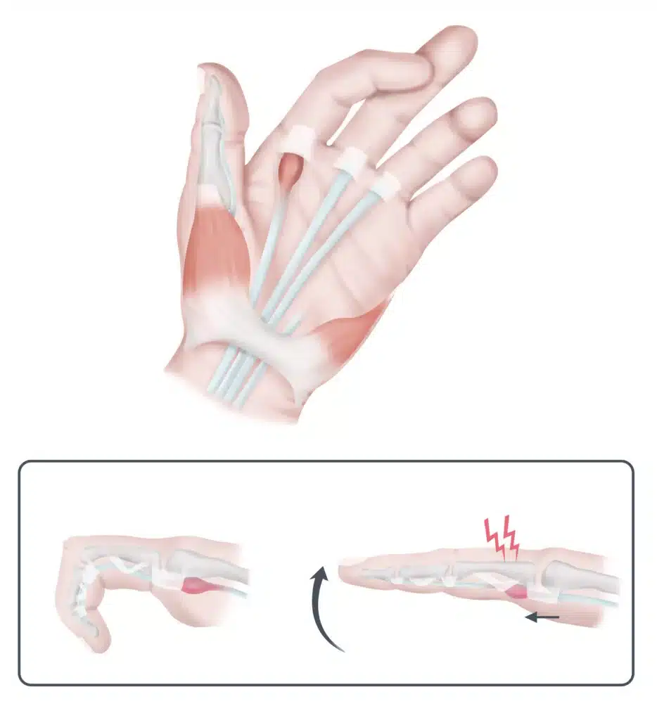 anatomia dito a scatto