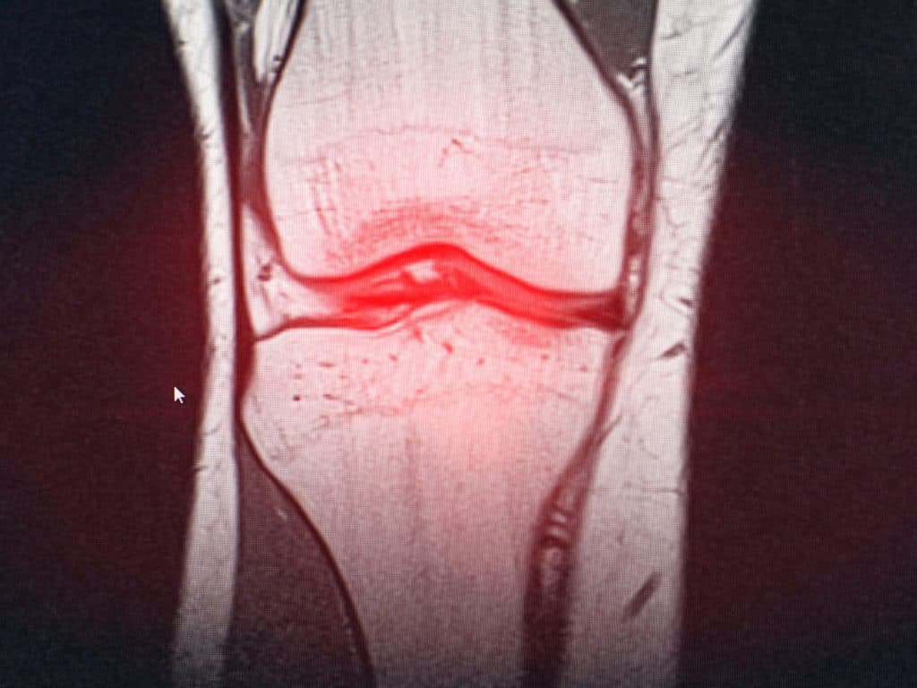 lesioni meniscali