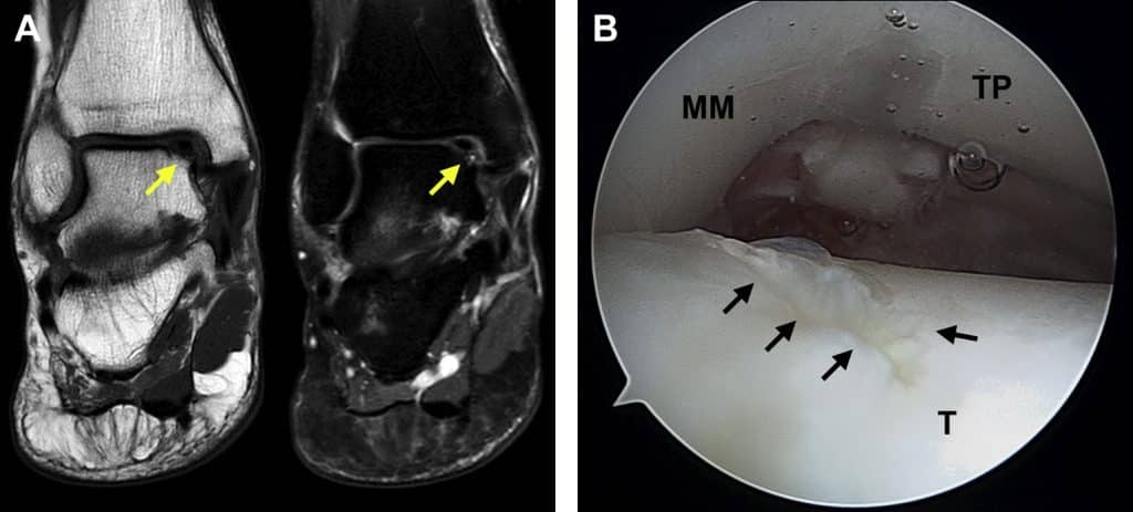 Lesione osteocondrale astragalo