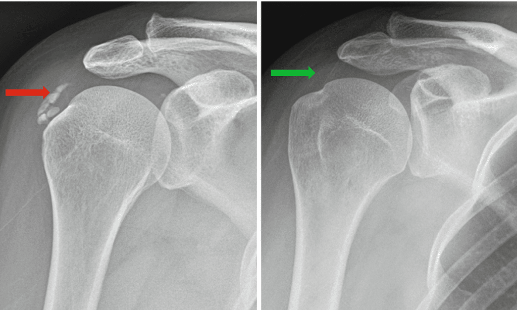 tendinite calcificante