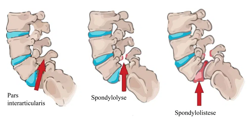 spondilolistesi