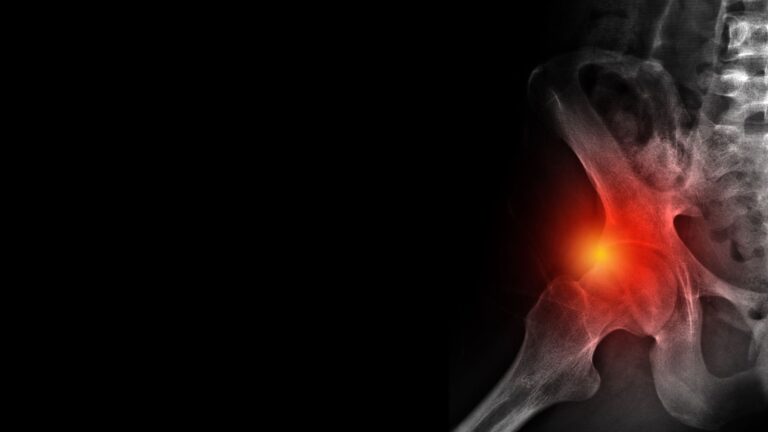Sindrome da impingement femoro-acetabolare: trattamento conservativo