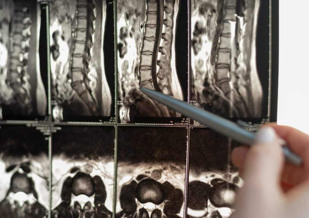 sindrome cauda equina