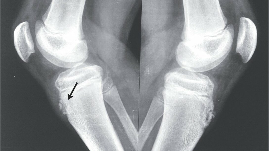 sindrome di osgood schlatter