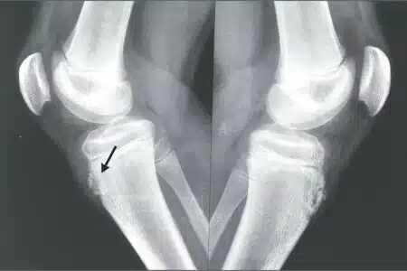 sindrome di osgood schlatter