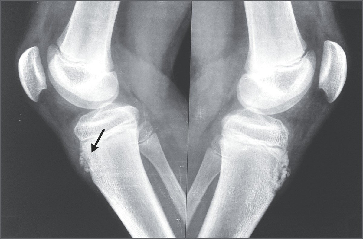 Morbo di OsgoodSchlatter FisioScience
