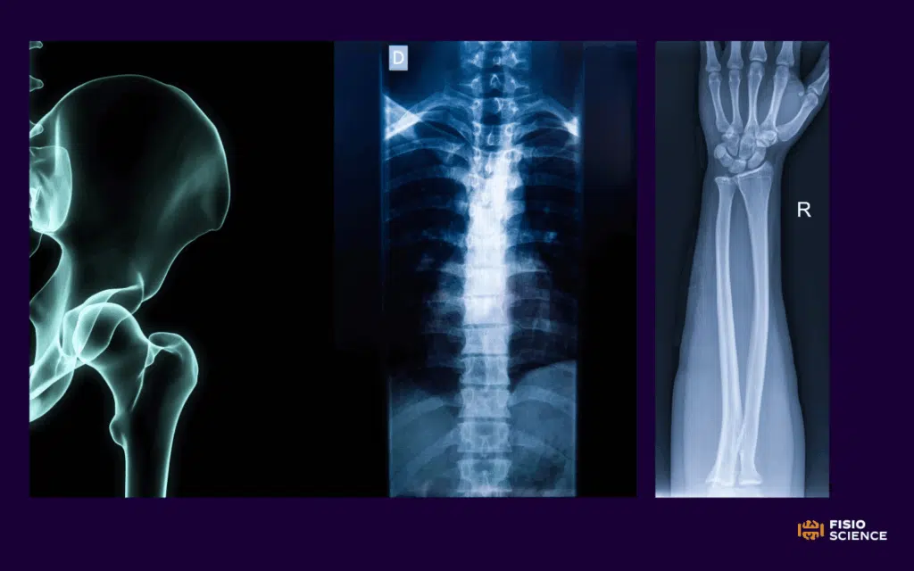 osteoporosi