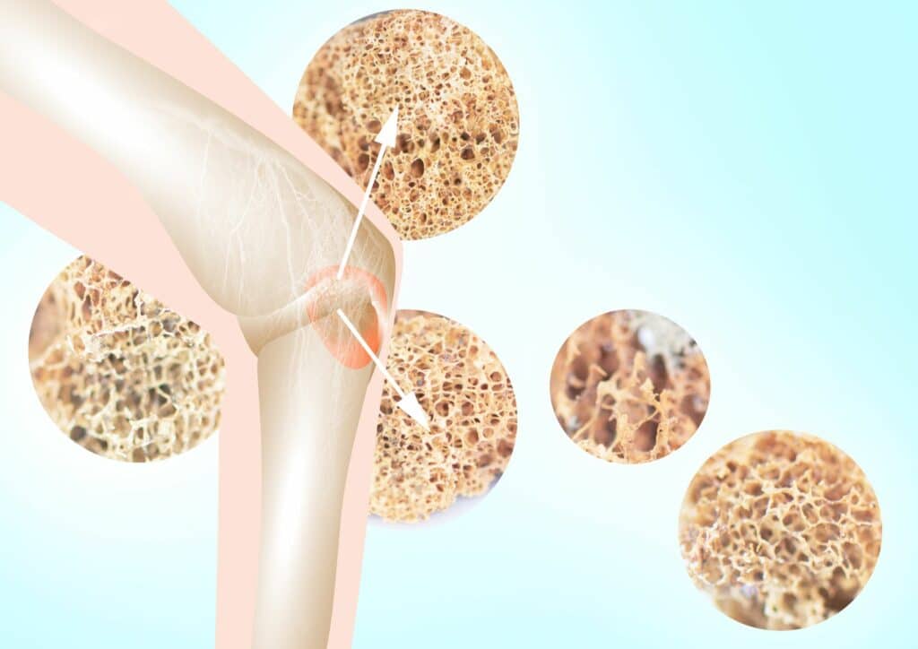 osteoporosi