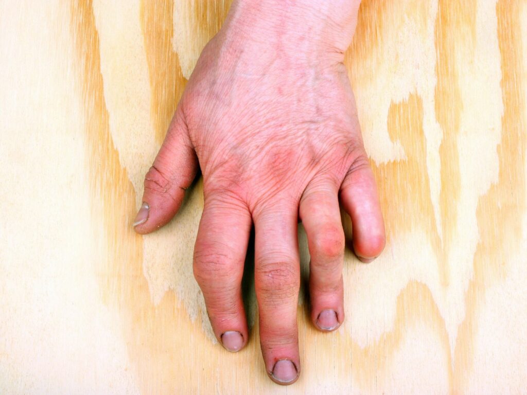 artrite reumatoide