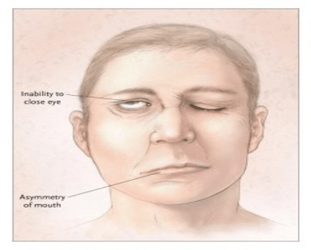 sintomi-paralisi-nervo-facciale