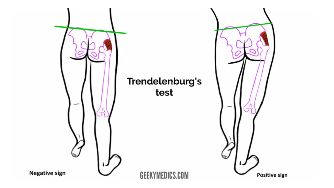 segno di trendelemburg