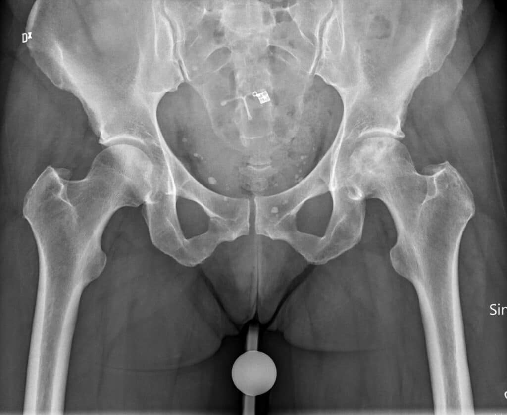 osteonecrosi della testa del femore
