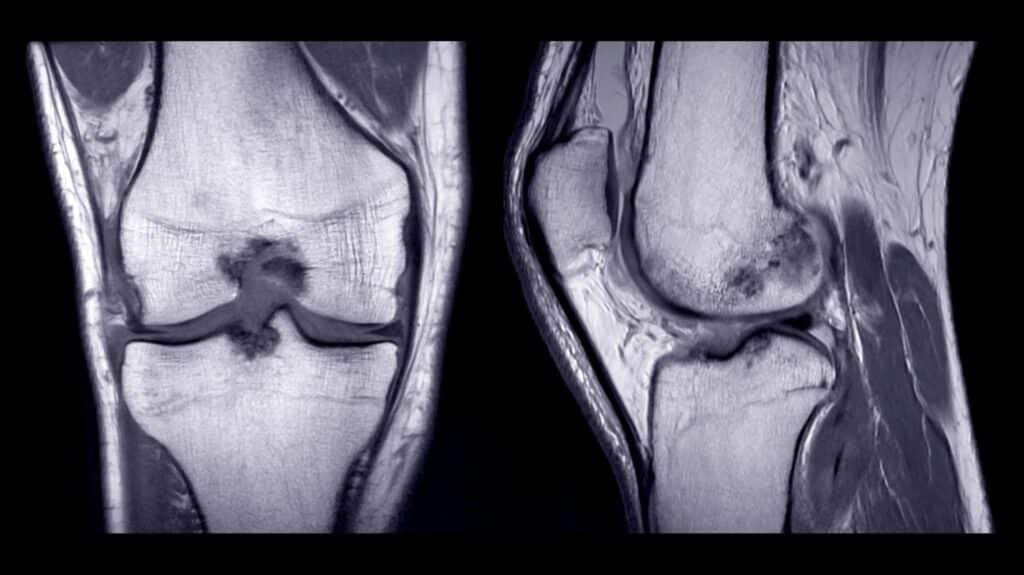 edema osseo copertina