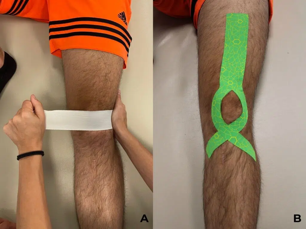 lussazione di rotula: tape