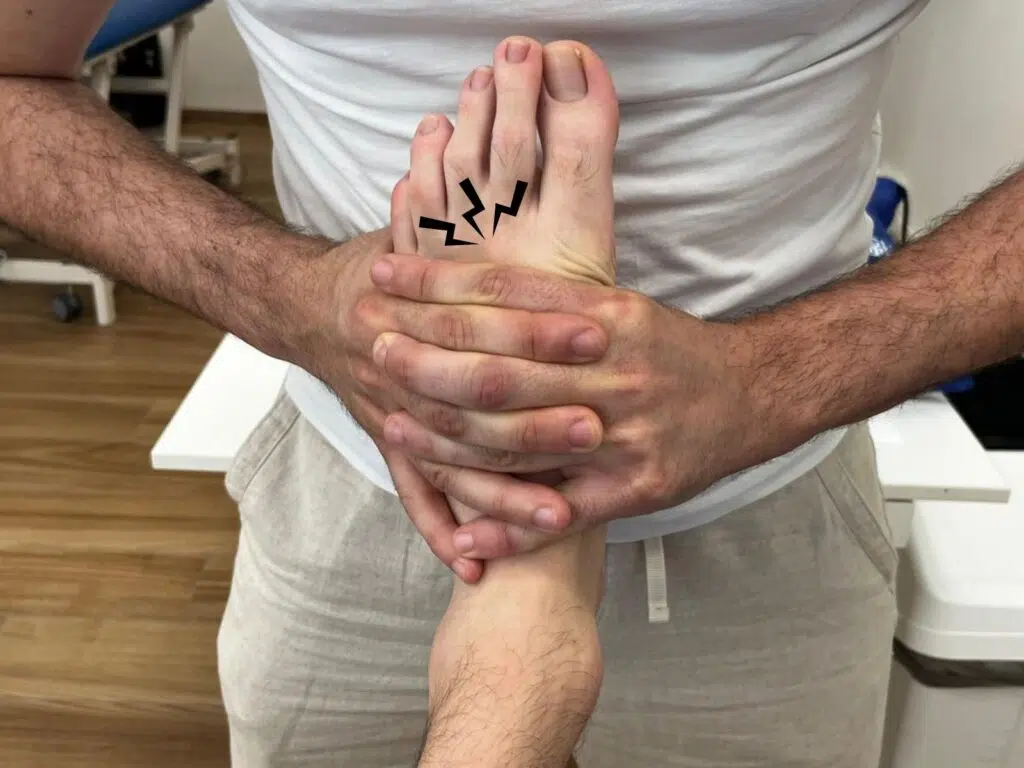 neuroma di Morton: foot squeeze