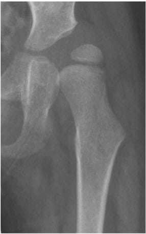 displasia dell'anca radiografia