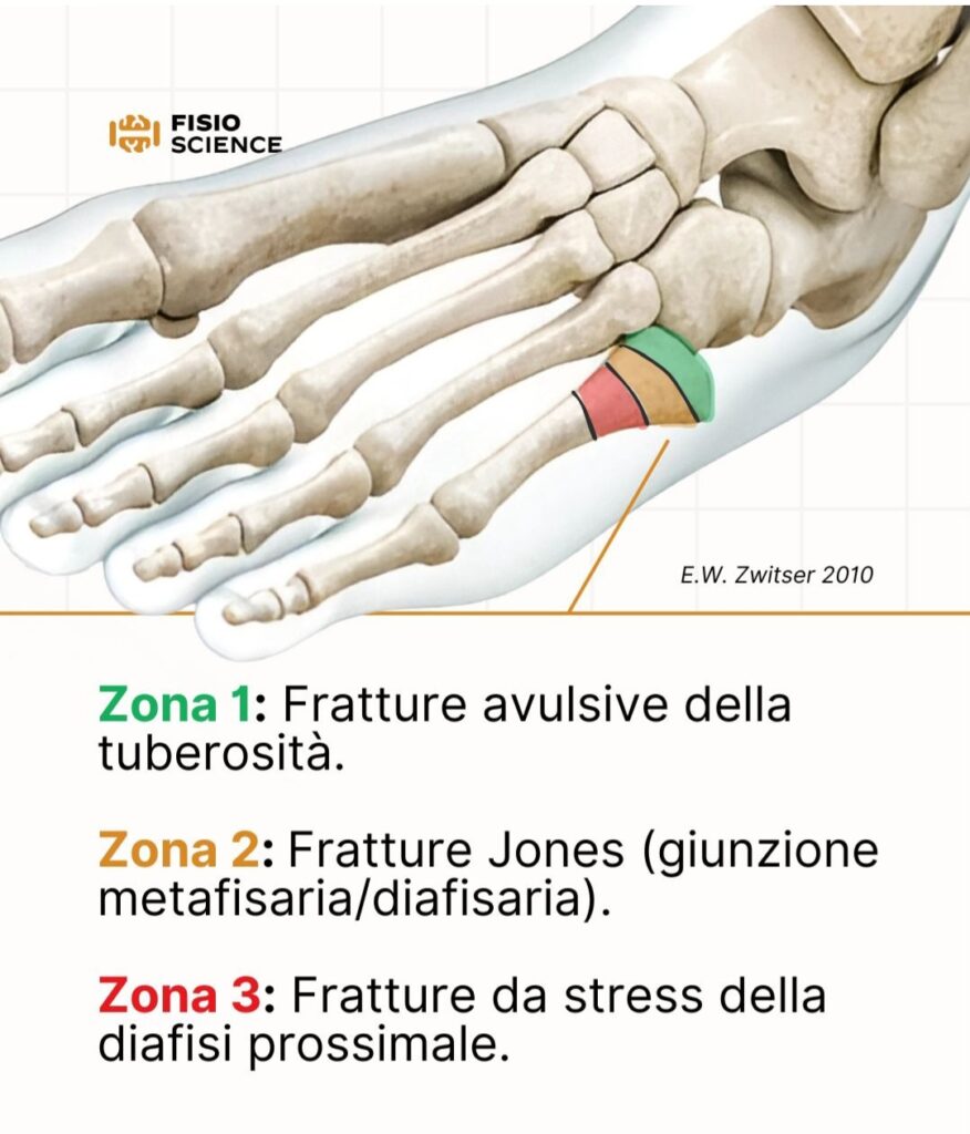Frattura di Jones: zone