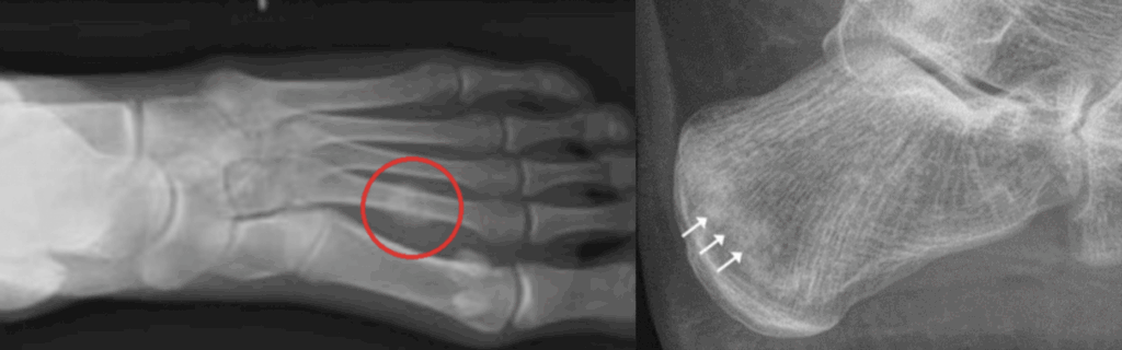 fratture da stress piede radiografia