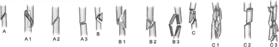 classificazione fratture omero
