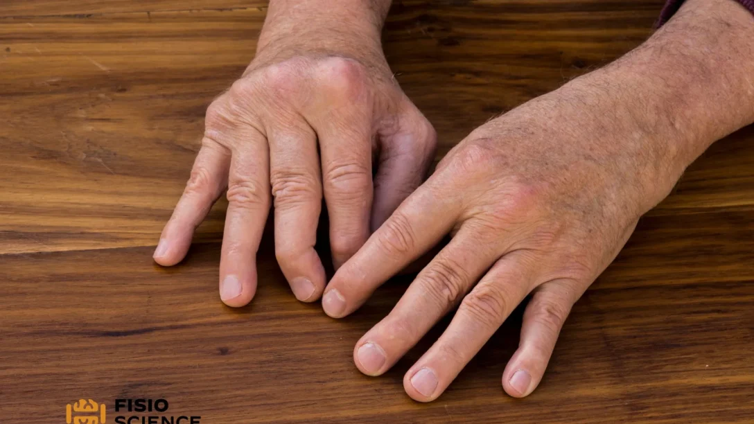 Artrite Psoriasica cover