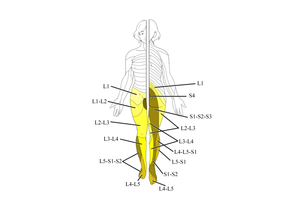 Lombocruralgia: dermatomeri