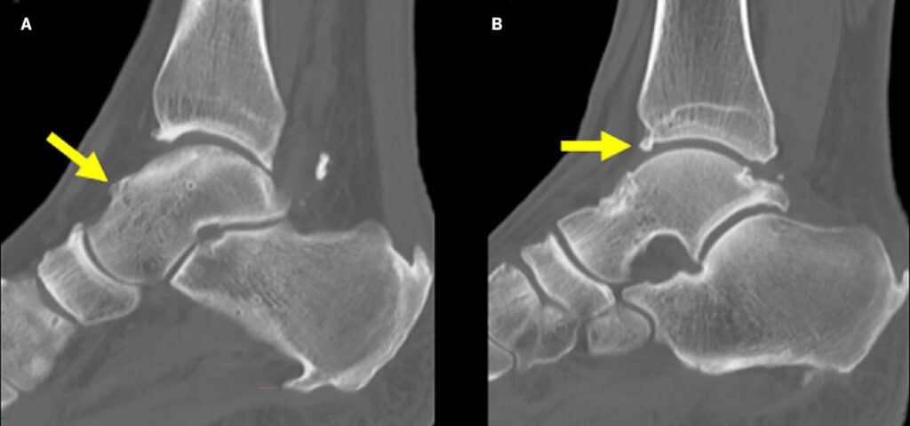 Impingement anteriore di caviglia radiografia