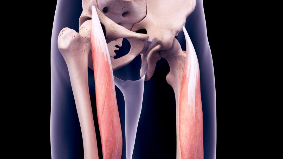 retto femorale lesione fisioscience