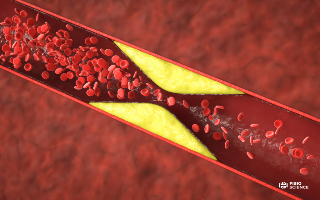 Claudicatio vascolare