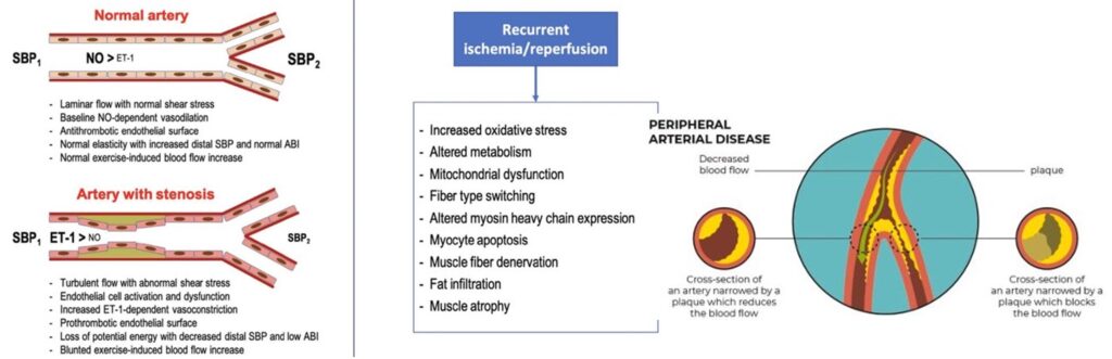 patofisiologia claudicatio vascolare