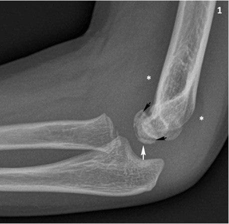 Sindrome di Panner: rx.