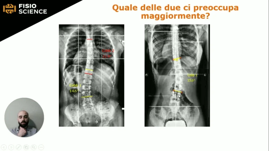 masterclass-scoliosi-lesson-02-1