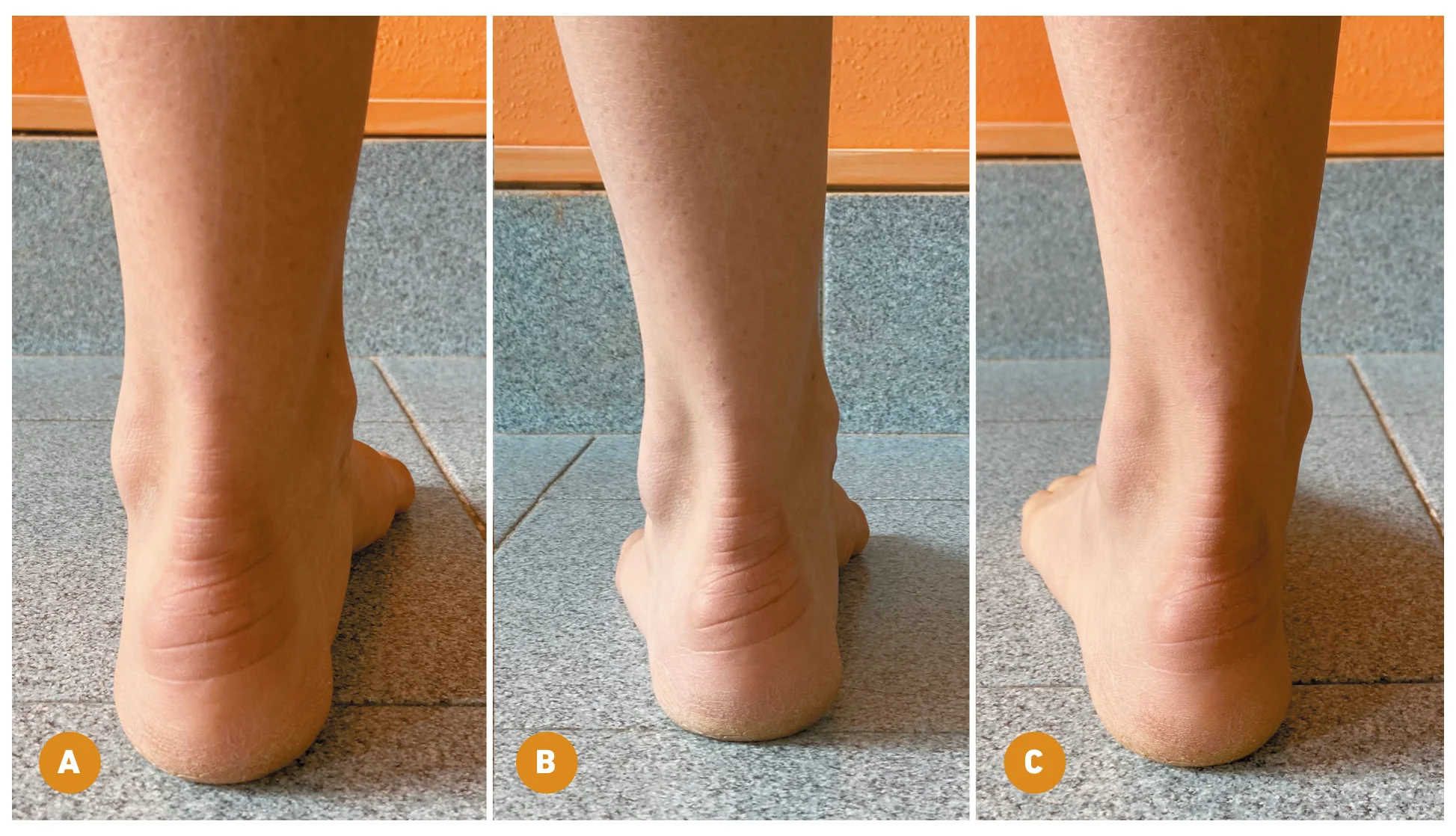 Foot Posture Index item 6, abduzione dell'avampiede vista da dietro